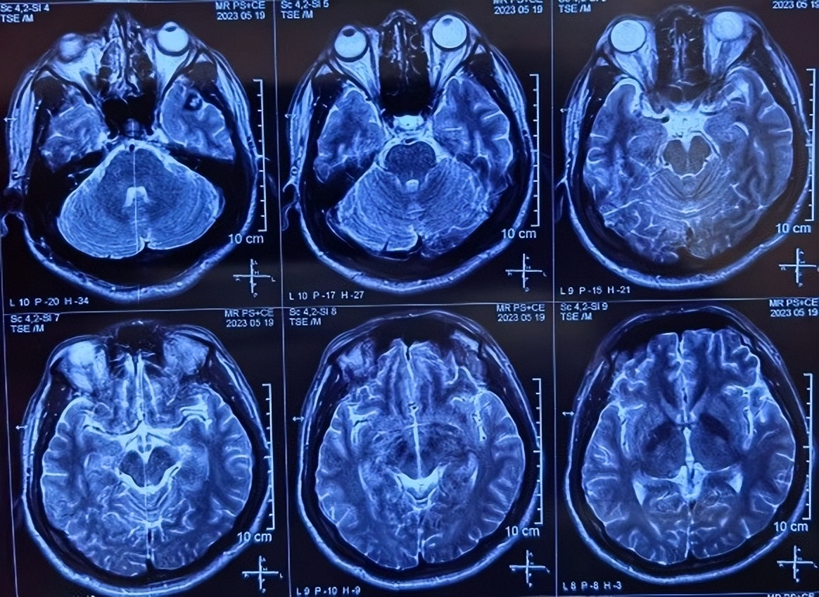 癫痫病灶可能有几个,癫痫频发