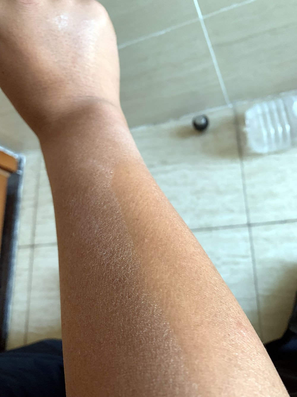 一到秋冬季双手就脱皮怎么治疗,一到春天手心就开始干燥脱皮