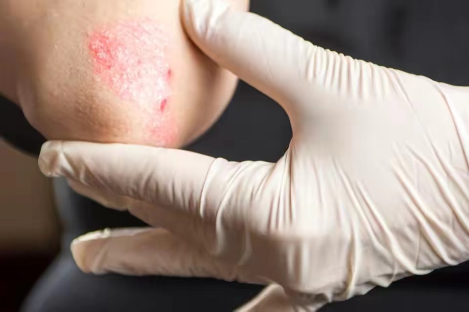 皮肤病防治秘籍大全,史上最全的皮肤病治疗