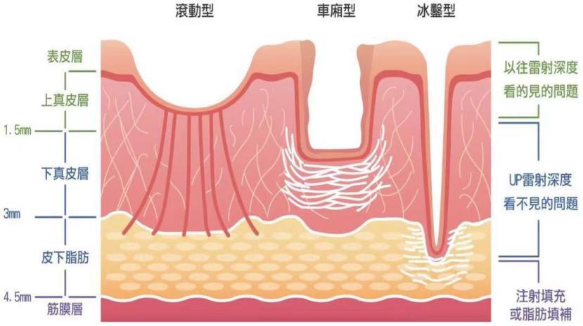 青春痘逆袭的方法,16岁青春期学生痘印如何改善