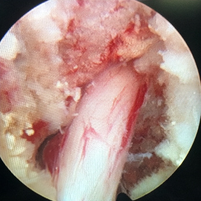 门医技术|门头沟区医院骨二科成功应用微创椎间孔镜技术治疗两例腰椎管多节段狭窄症