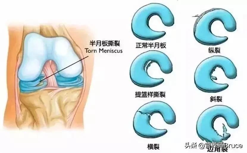 针灸对半月板损伤有作用,半月板损伤服用氨糖有作用吗