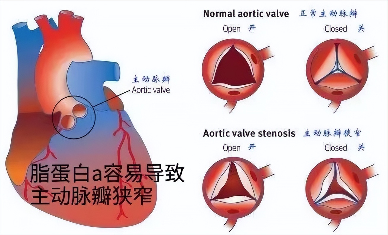 脂蛋白a高需要打降脂针吗,脂蛋白a高会引起心脏骤停吗