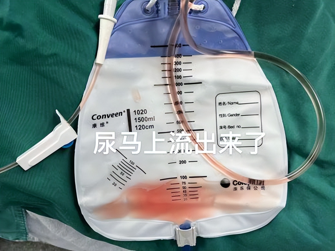 直肠癌转移的方式,直肠癌转移盆腔化疗方案