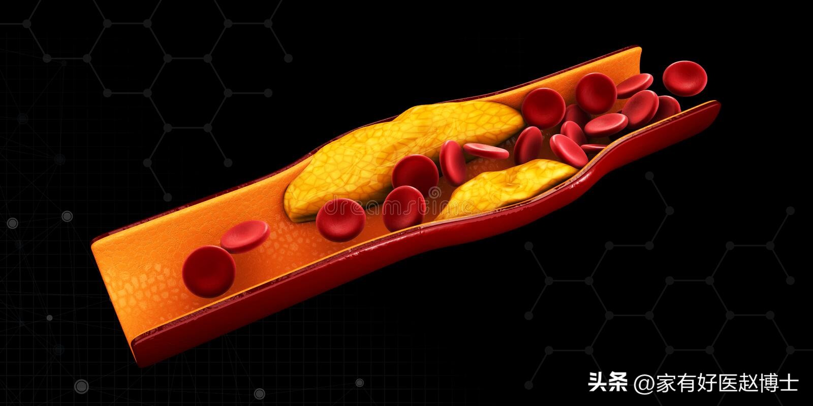 颈动脉没有斑块可以停用他汀吗,一般他汀吃多久颈动脉斑块有效果
