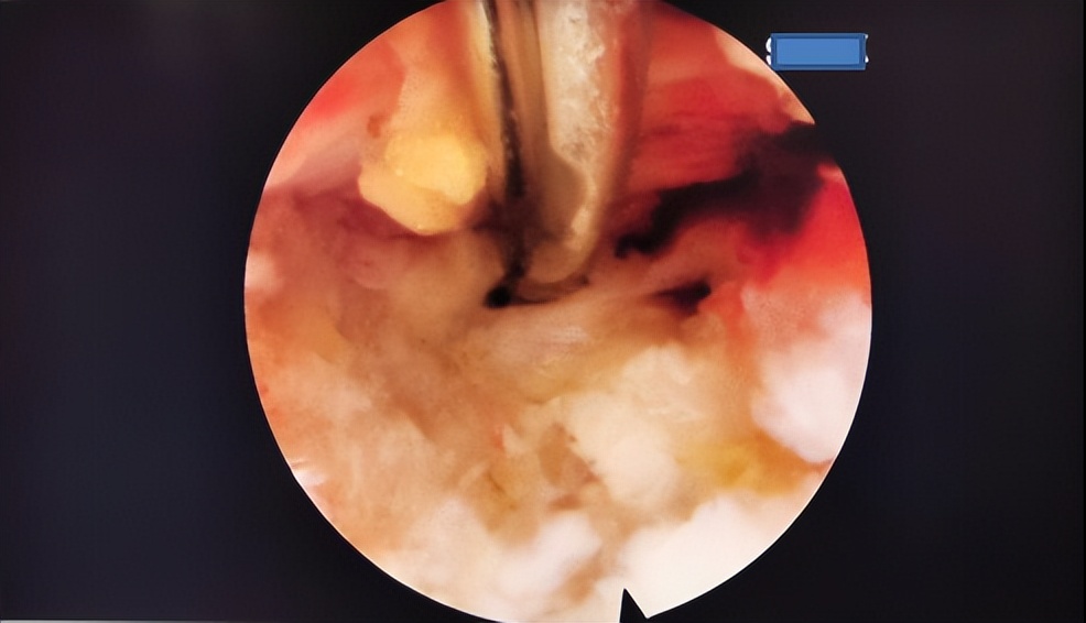 腰椎间盘突出微创姑息法,38岁腰椎间盘突出微创