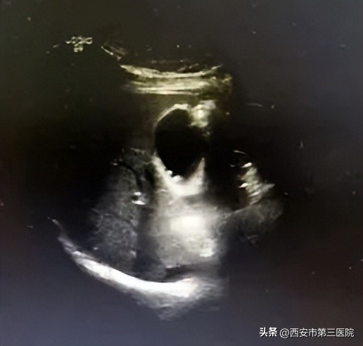 超声造影能鉴别胆囊息肉的性质吗,超声提示胆囊息肉样变什么意思