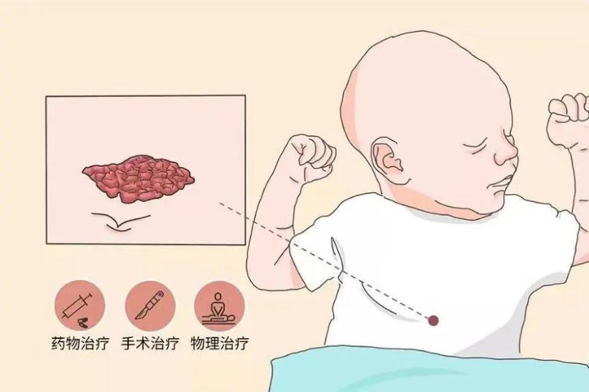 癫痫性血管瘤,海绵状血管瘤开颅后癫痫症状