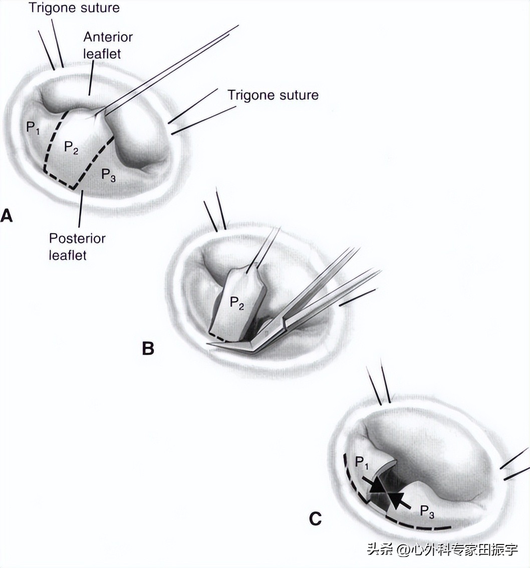 二尖瓣成形术,二尖瓣成形术后需要静养多久