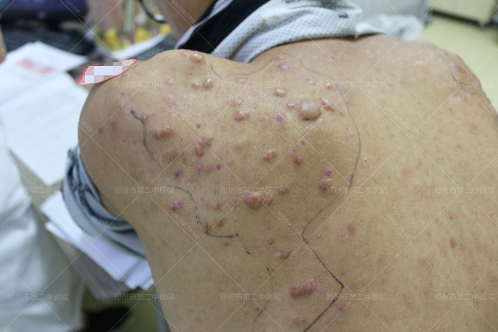 郑大一附院疤痕疙瘩怎么去除,中医怎样治疗增生性疤痕疙瘩