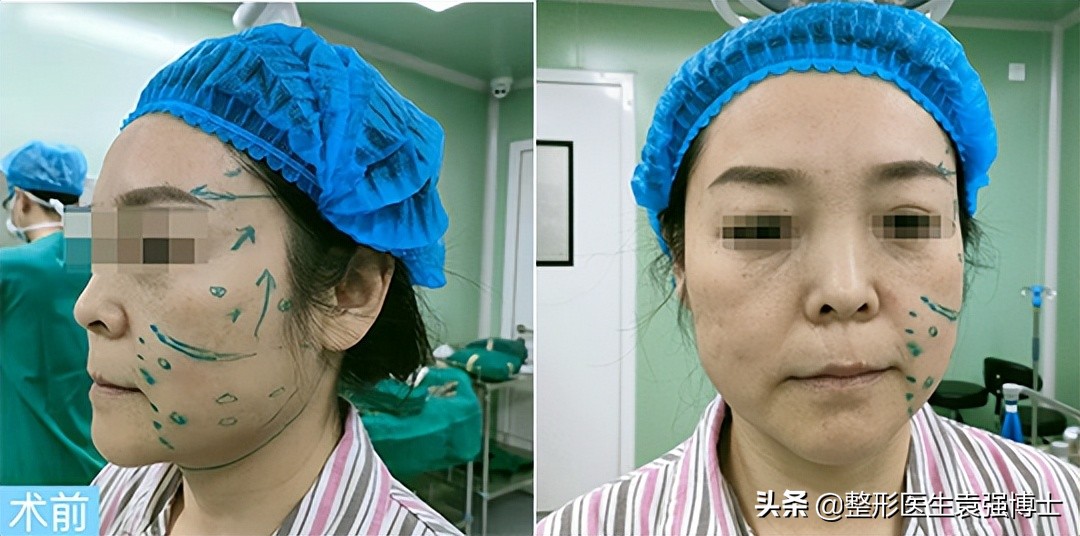 小拉皮15天能恢复自然么,小拉皮恢复的真实感受案例