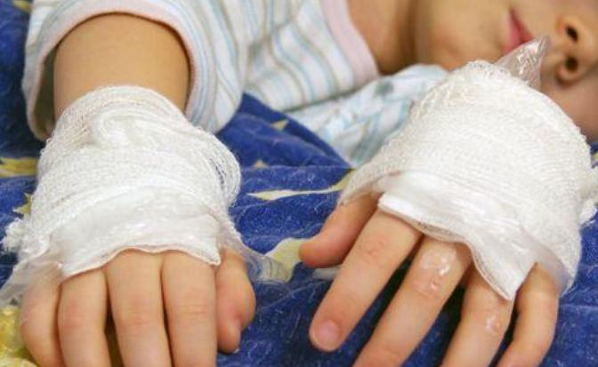 小孩被开水烫伤怎么办最快最有效,小孩被开水烫伤怎么处理最好恢复