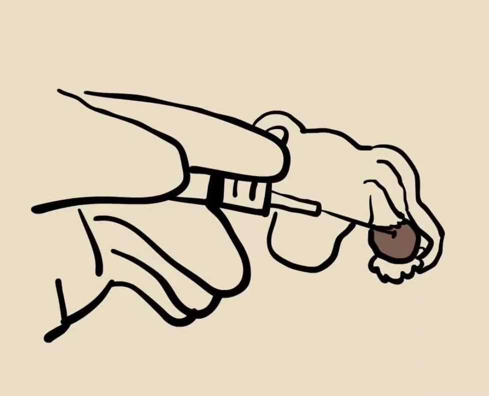 巧克力囊肿微创和痔疮一起割吗,女性巧克力囊肿微创治疗