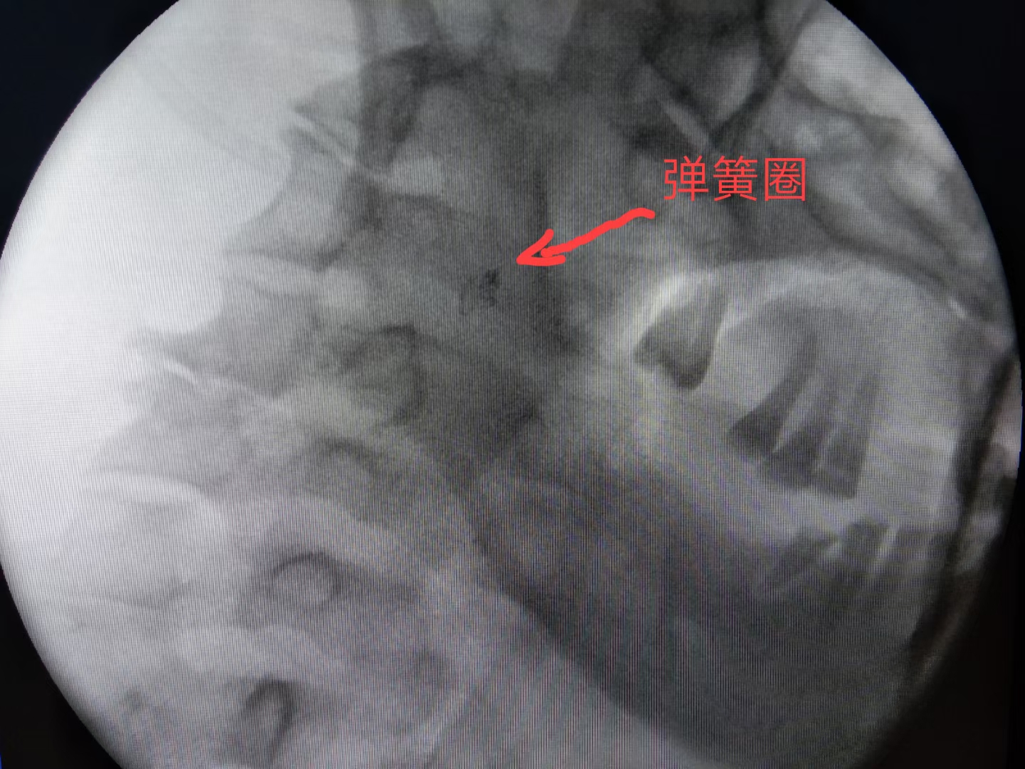 「病例分享」舌癌患者突发大出血，燥动不安，介入治疗成功止血