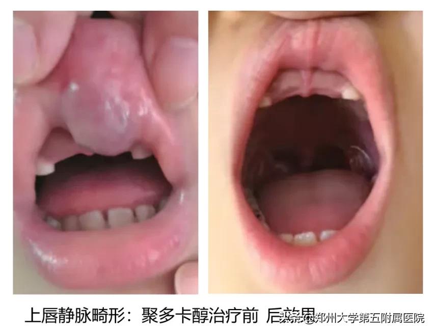 健康科普治疗结节,静脉畸形有硬肿块要做手术吗