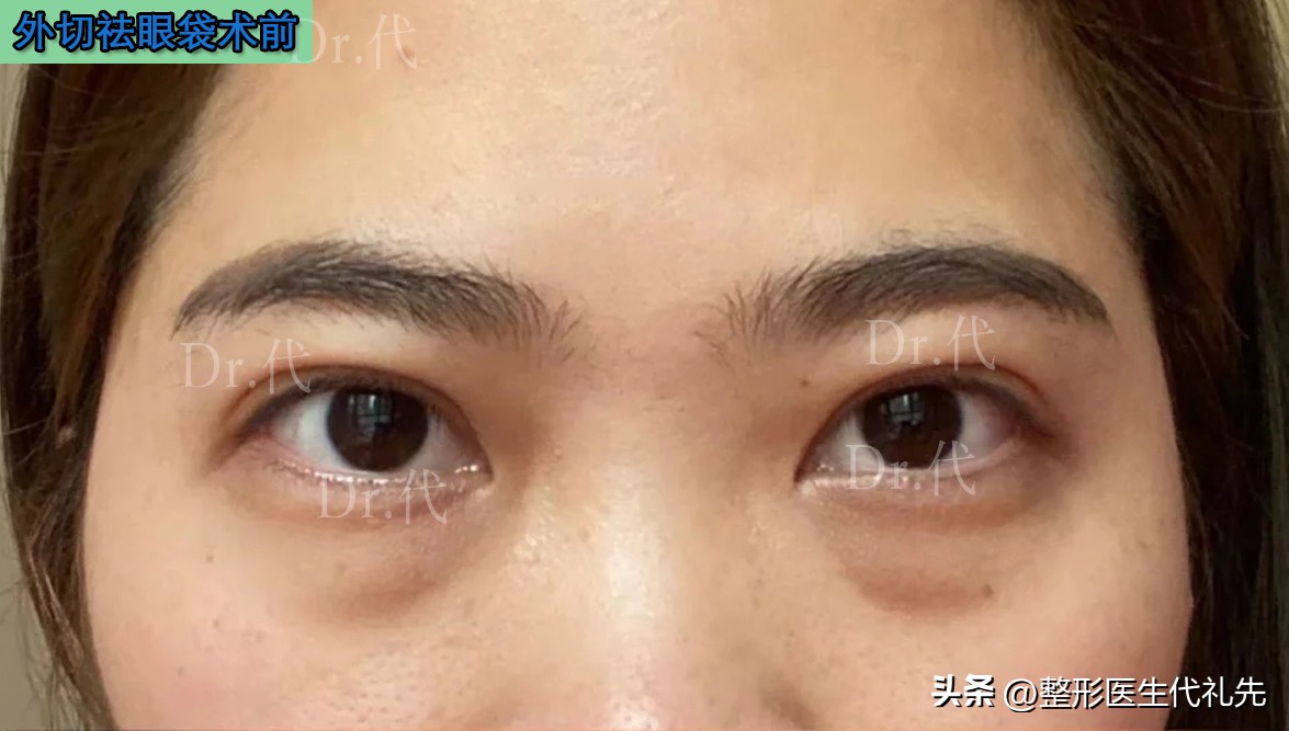 外切眼袋眼睑退缩修复手术对比,50岁外切眼袋手术真实感受