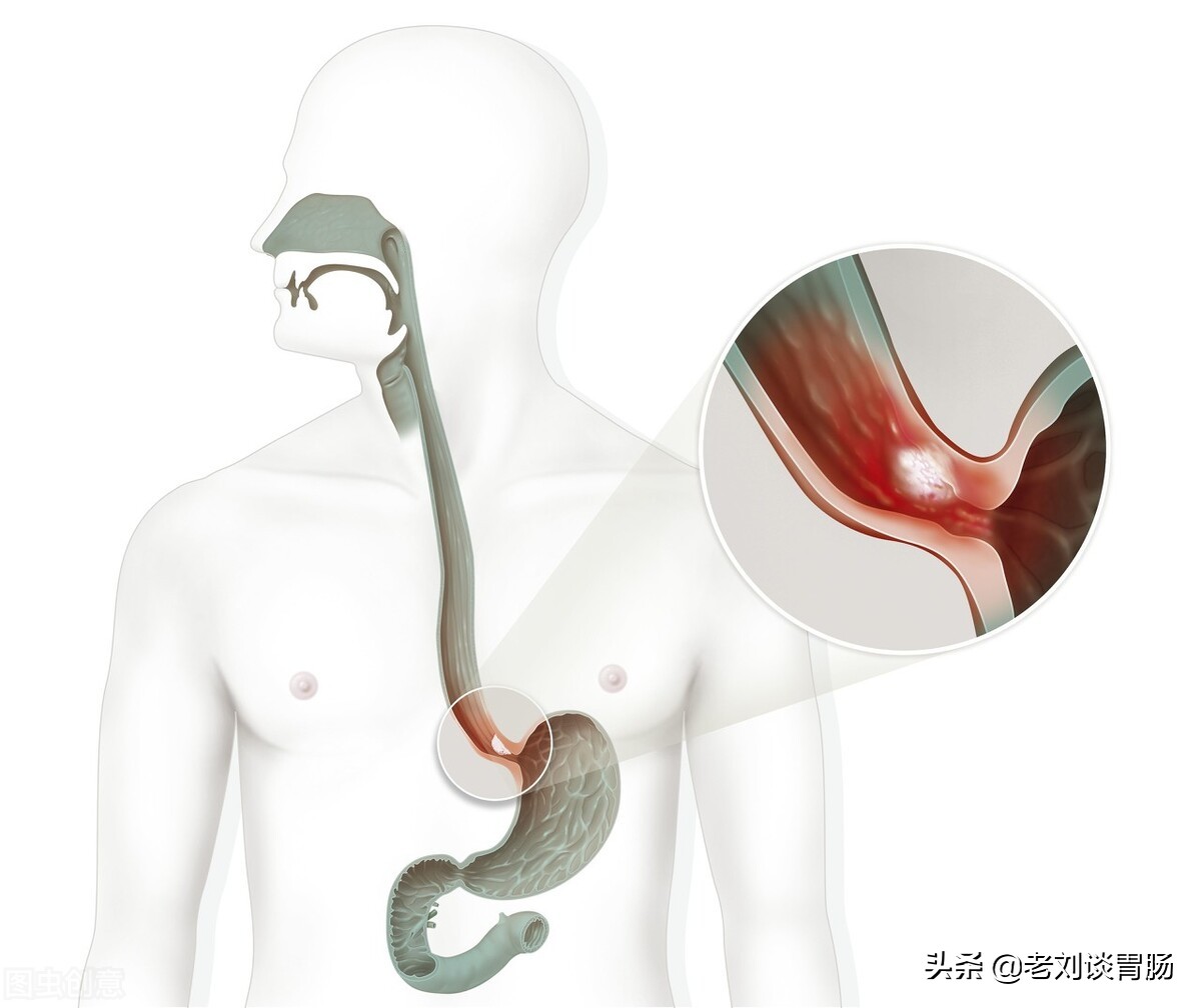 怎么看懂胃镜报告,如何看懂胃镜报告单呢