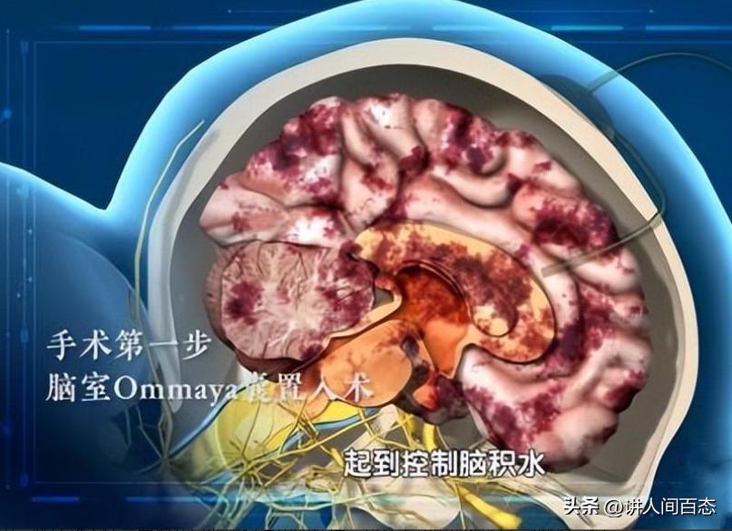 被丢在桥洞下的孩子后续,孩子被遗弃后脑长肿瘤