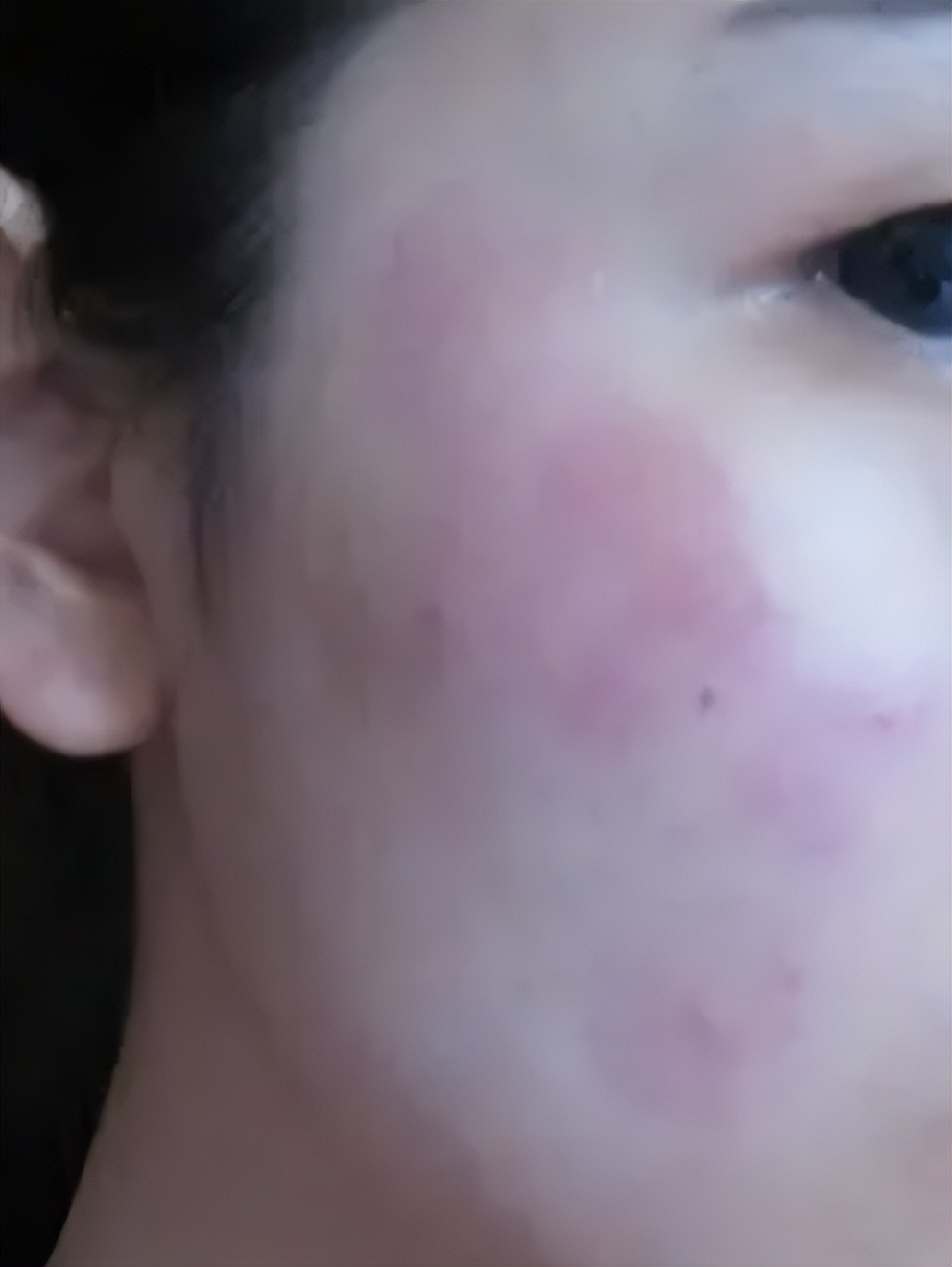 春季皮炎用什么药膏,春季皮炎治疗方法有哪些