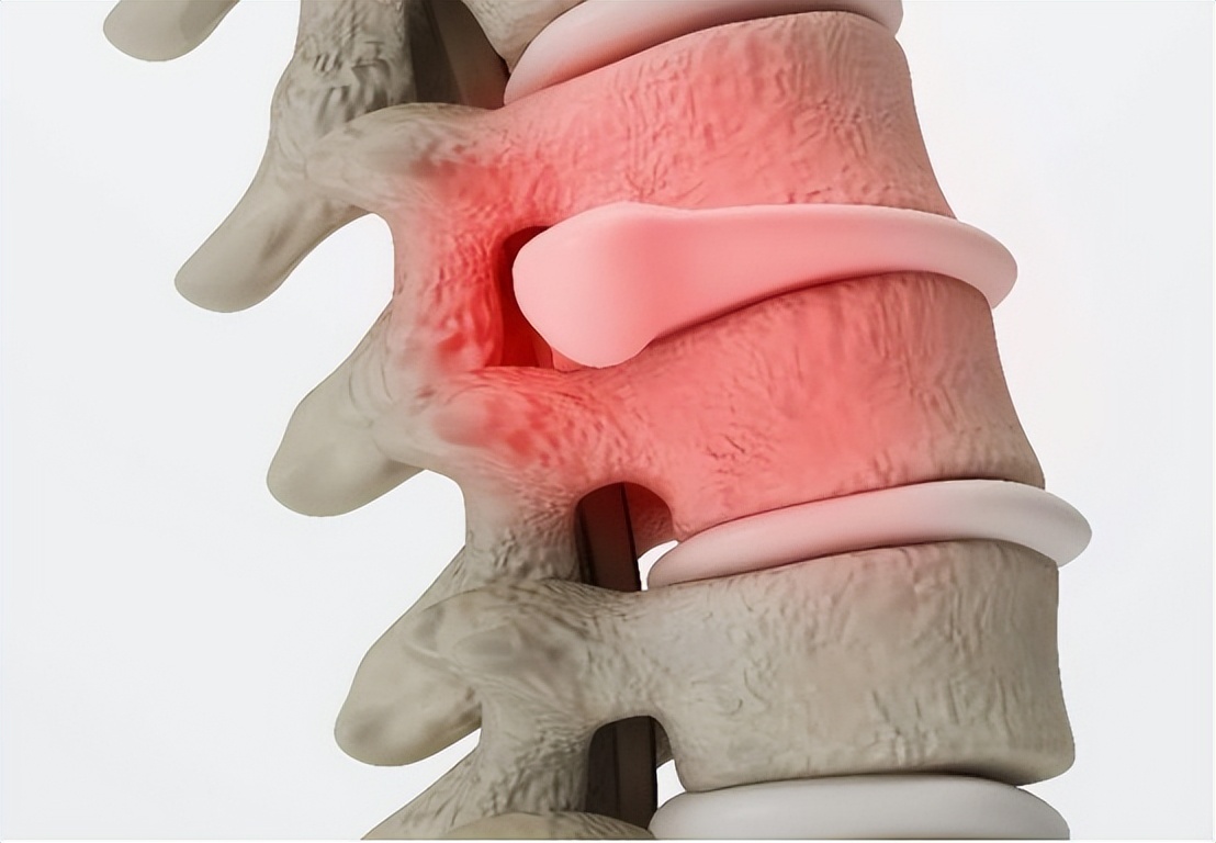 修复腰椎间盘突出，对症下药，多种手段齐上阵