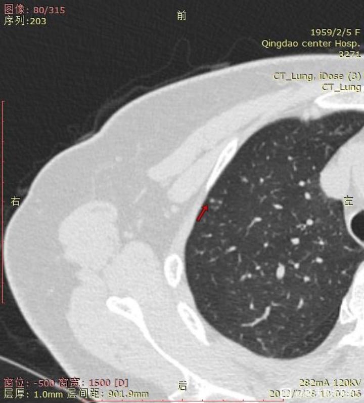 3个月内磨玻璃结节,多发磨玻璃结节3个月后减少