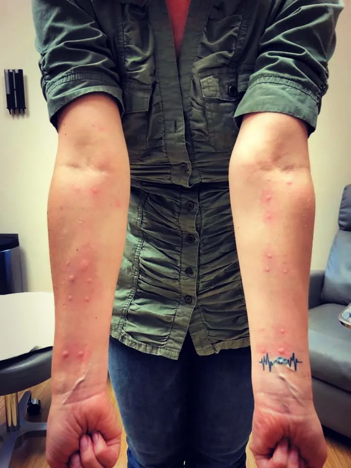 被蜱虫咬能死吗,被蜱虫咬了一辈子不能吃肉吗