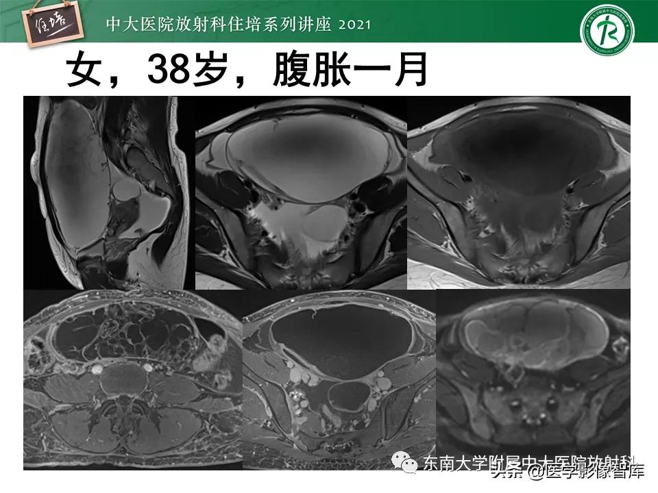 卵巢浆液性肿瘤的肉眼及镜下特征,卵巢原发性粘液性囊腺瘤