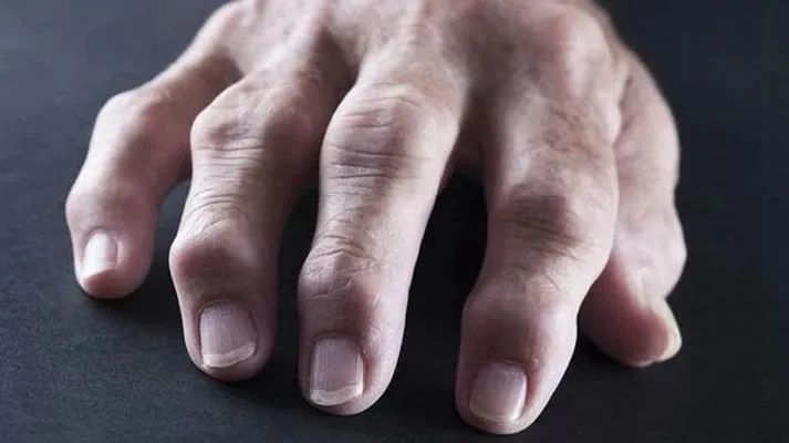 风湿骨病一般是痛在哪些部位,风湿骨病造成关节疼是哪里疼