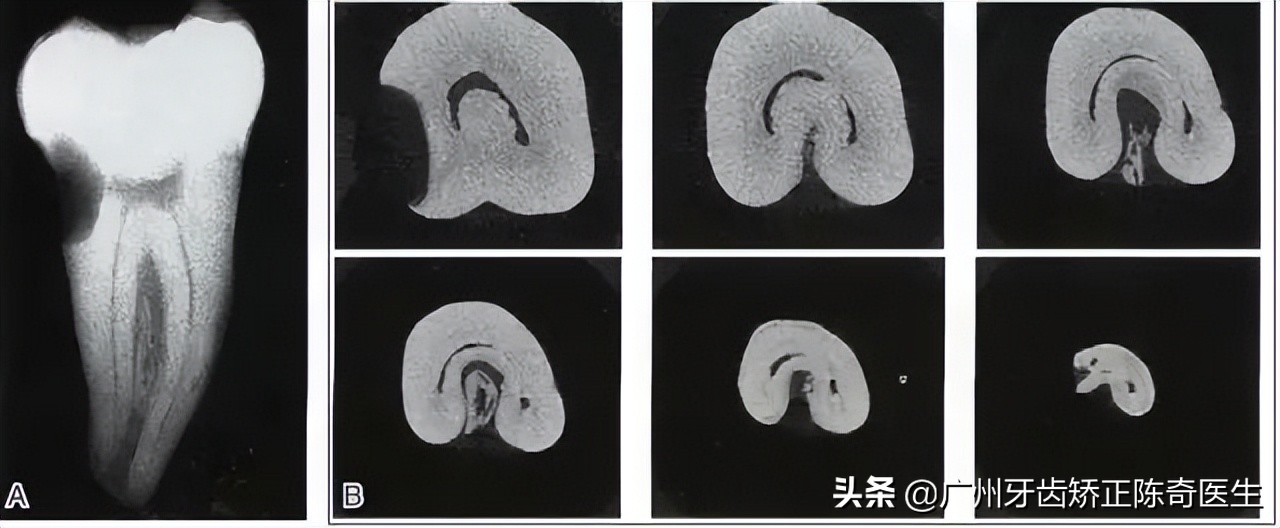 蛀牙在ct上如何看出来,拍ct发现蛀牙蛀成笑脸