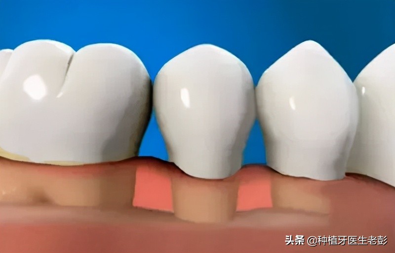 咨询医生治疗牙周炎,我想种植牙