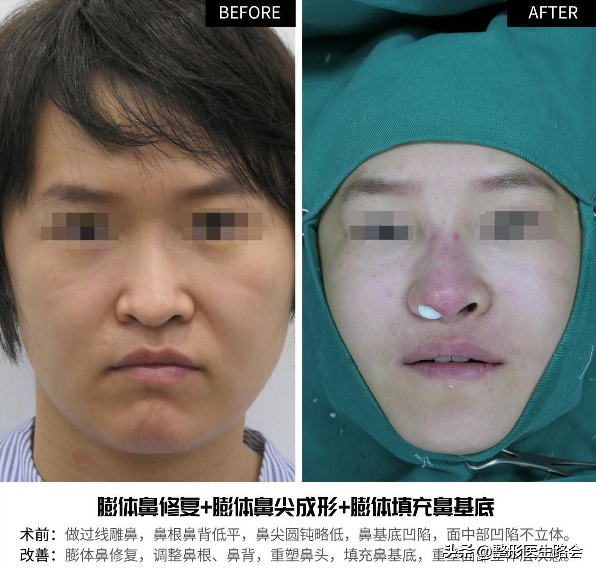 隆鼻三年后可以蹦极嘛,做了隆鼻到底可以蹦极吗