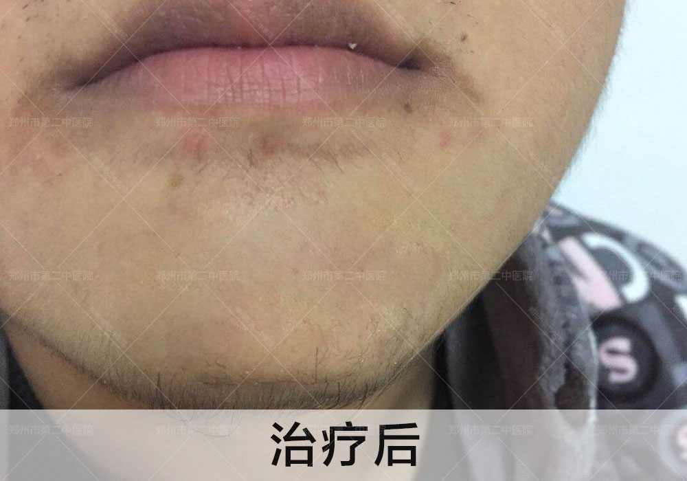 郑州哪个医院祛缝针疤最好,郑州第二中医院怎么祛疤痕