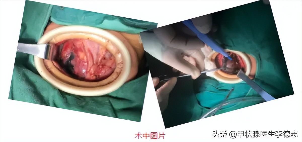 甲状腺癌实例,甲状腺乳头状癌半切和全切
