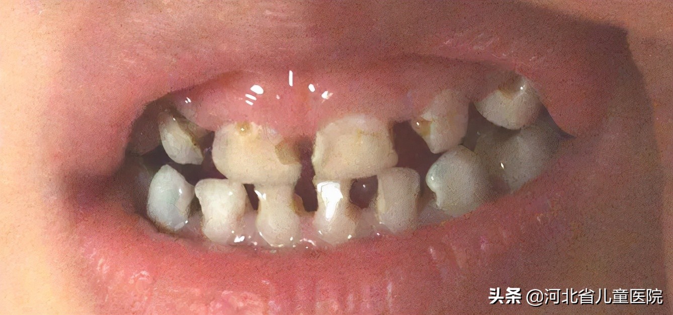 前牙龋坏修复好的案例,牙面龋坏修复全过程