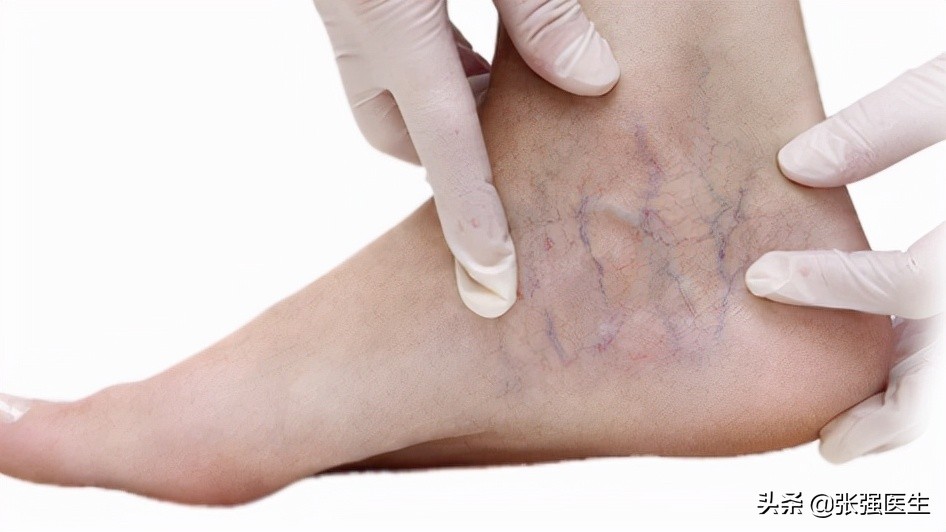 腿上出现蜘蛛网状血管怎么治疗,腿上蜘蛛状毛细血管是什么病
