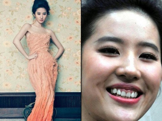 明星做烤瓷牙变凸嘴,明星烤瓷牙凸嘴