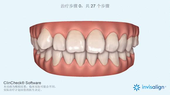 正畸治疗的基本矫治方法,正畸修复联合案例