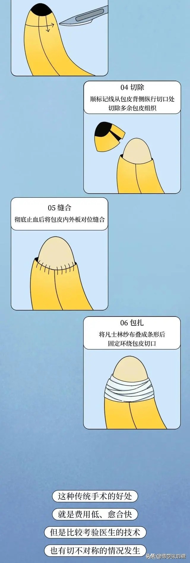 包皮手术后每一天的变化,做完包皮手术有什么感想
