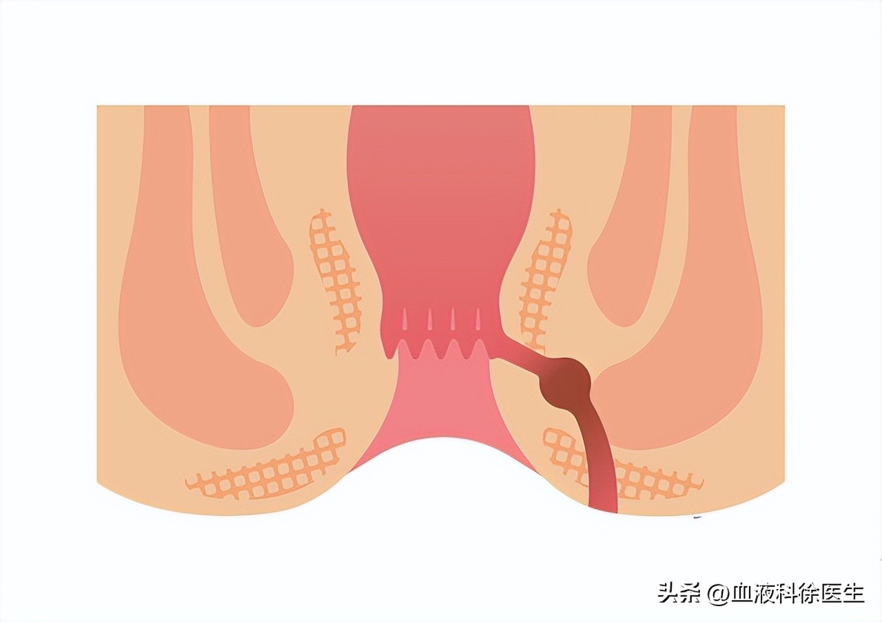 肛瘘手术不彻底医生有责任吗,肛瘘不想手术