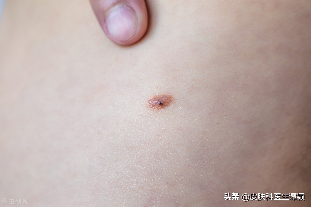 皮肤科医生谈白癜风,皮肤科医生谈论变白