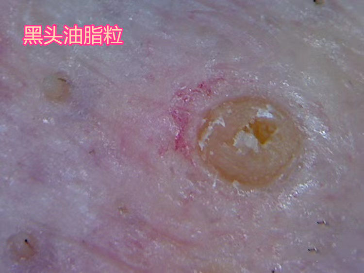 眉心鼻翼和下巴长粉刺为什么,鼻头上起粉刺什么原因引起的图片