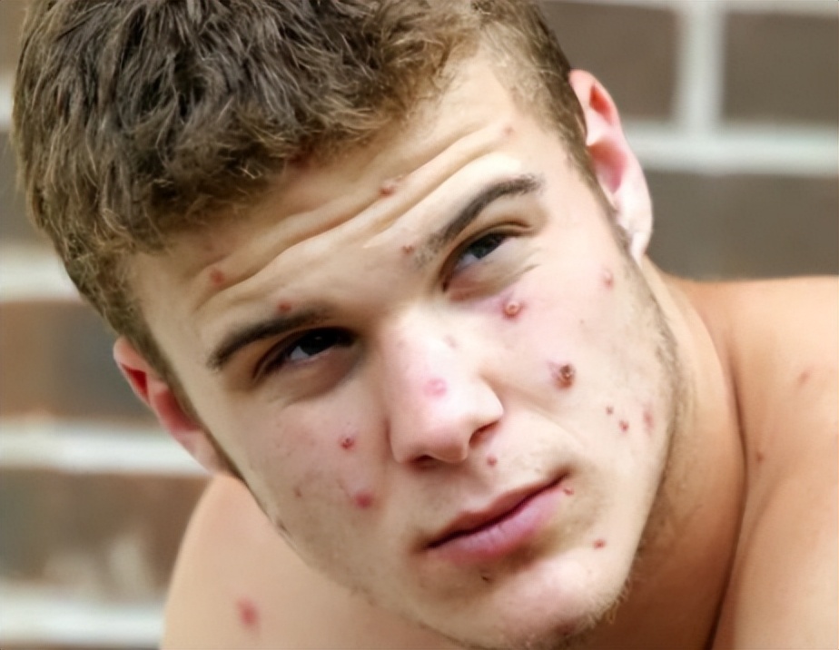 全球确诊38例猴痘病例,美国猴痘确诊病例数居全球首位