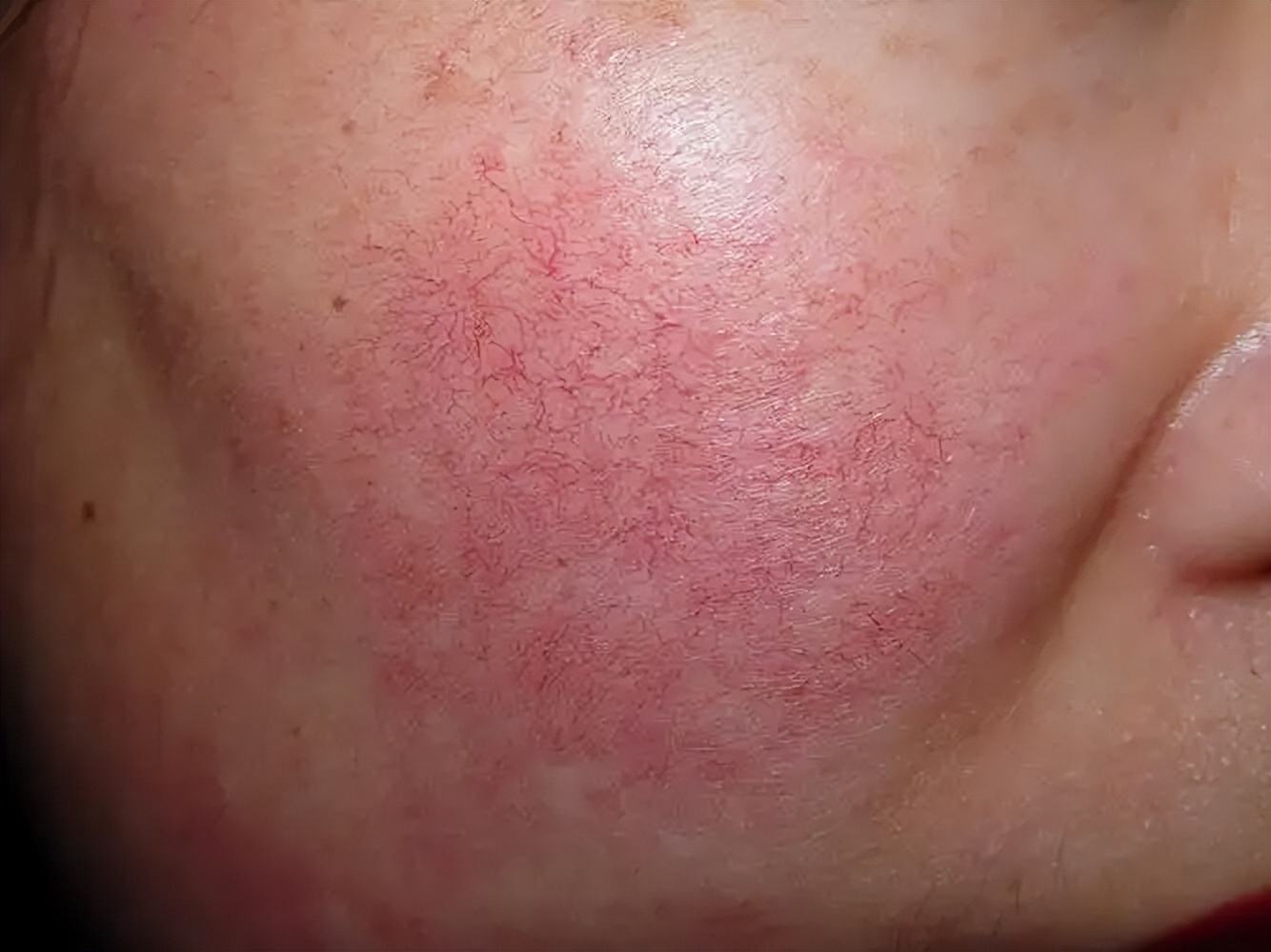 面部红血丝形成的六大原因看这里,脸上有红血丝是什么病的前兆吗