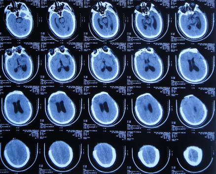 脑外伤后硬膜下积液颅骨修补,颅骨修复手术失败导致脑积水