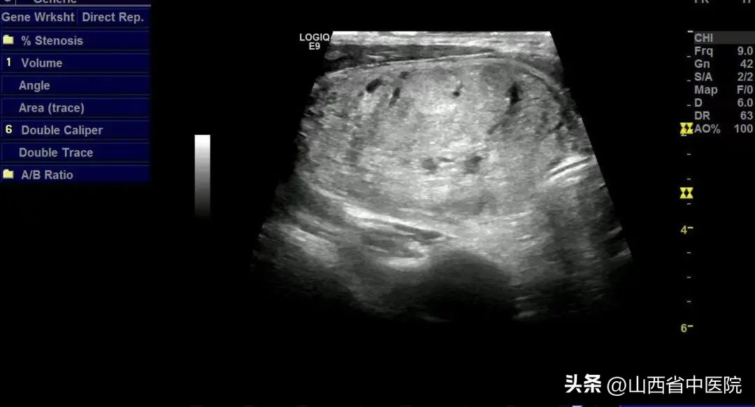 山西省肿瘤医院甲状腺结节消融,江苏省人民医院甲状腺结节消融术