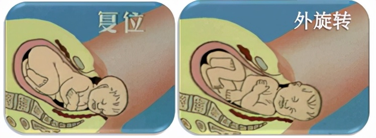 胎儿屁股在右侧是什么胎位,胎位roa屁股在左边还是右边