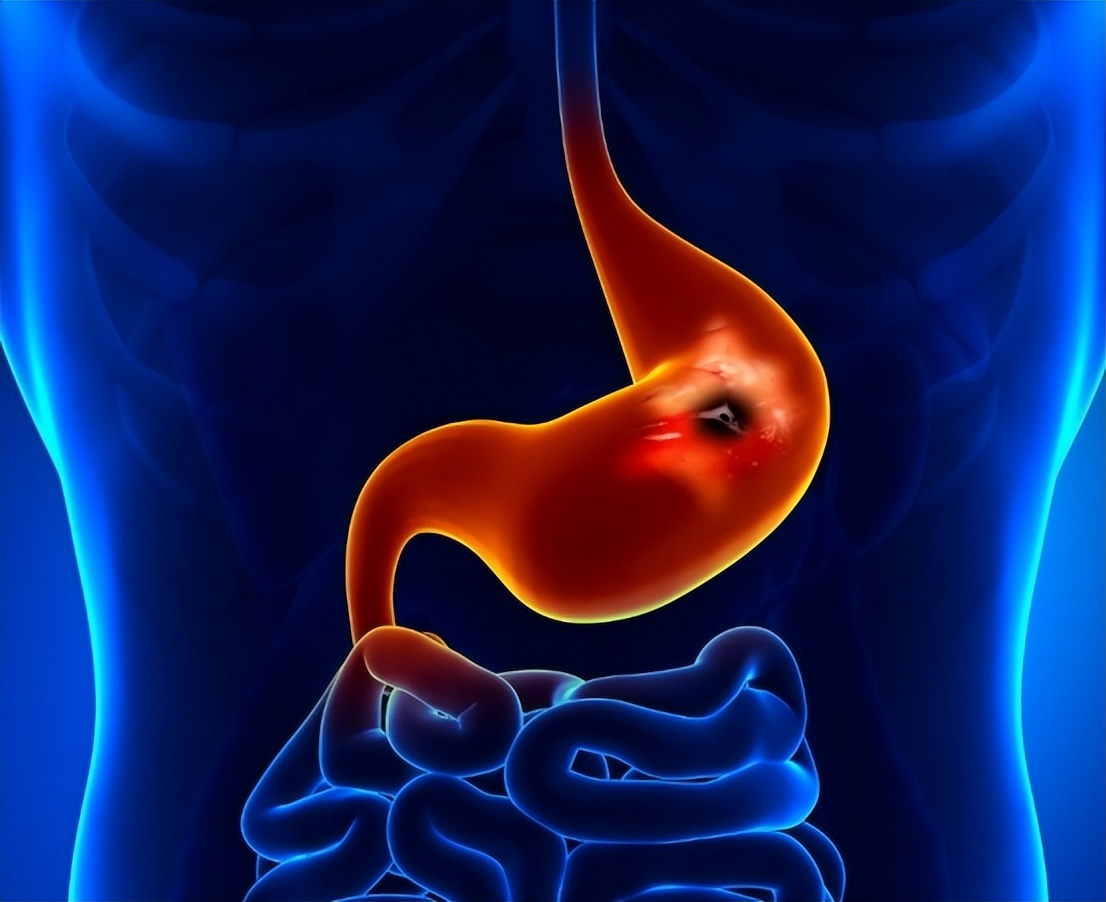 日本胃癌患病率为什么那么高,中国和西方国家患癌比例