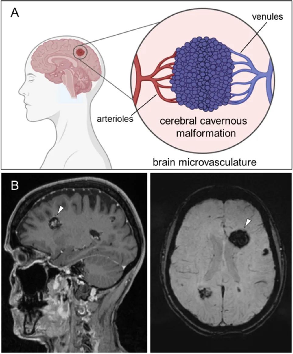 脑海绵状血管瘤引起癫痫怎么治,脑右侧顶叶海绵状血管瘤的危害