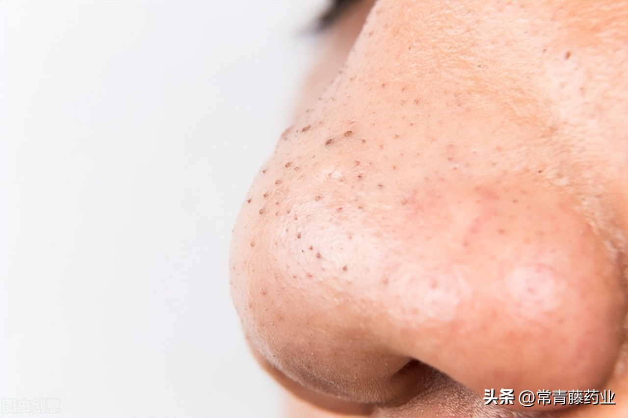 皮肤科医生教你两个月去掉黑头,如何去除黑头医生建议