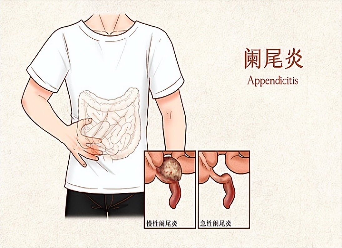 阑尾炎有什么症状表现在什么位置,阑尾炎的位置症状表现和治疗方法